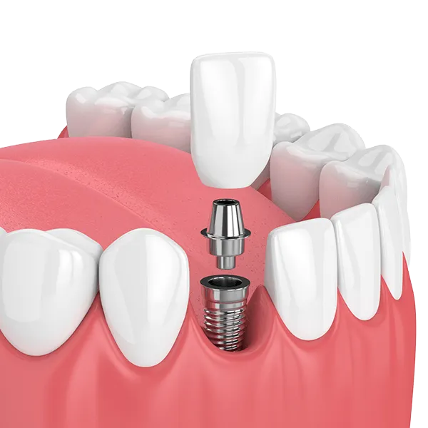 implante dentario