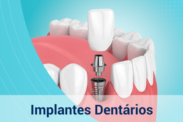 banner-destaque-implantes-dentarios